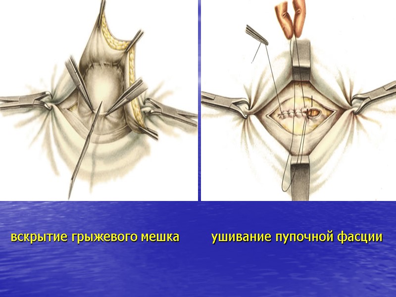 вскрытие грыжевого мешка ушивание пупочной фасции